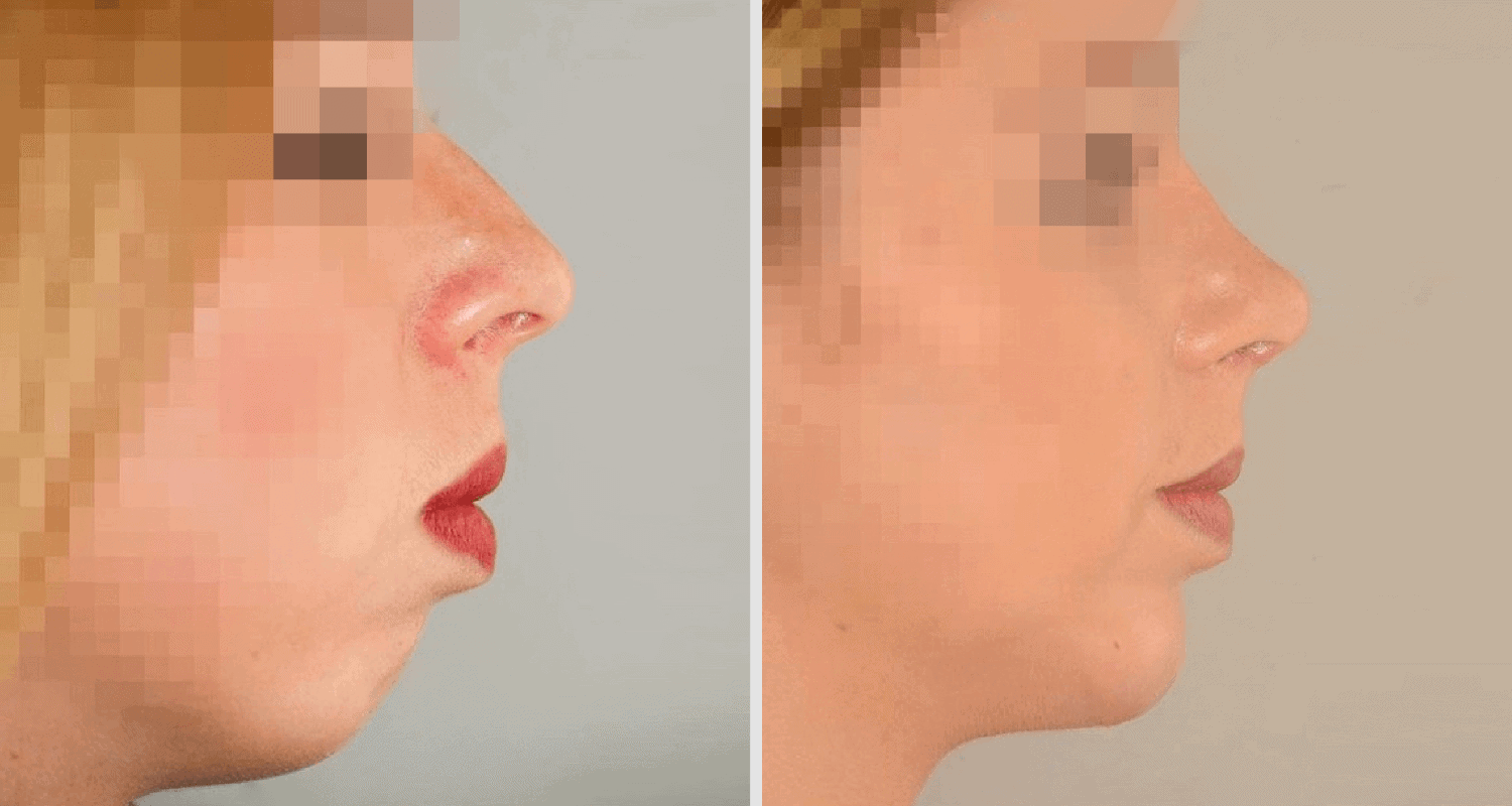 Vorher/Nachher Ergebnis: Kinnkorrektur Vergroesserung