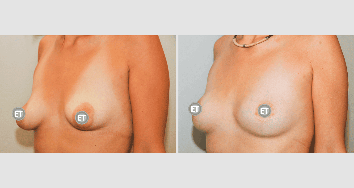 Vorher/Nachher Ergebnis: Mammatubulaere Deformitaet