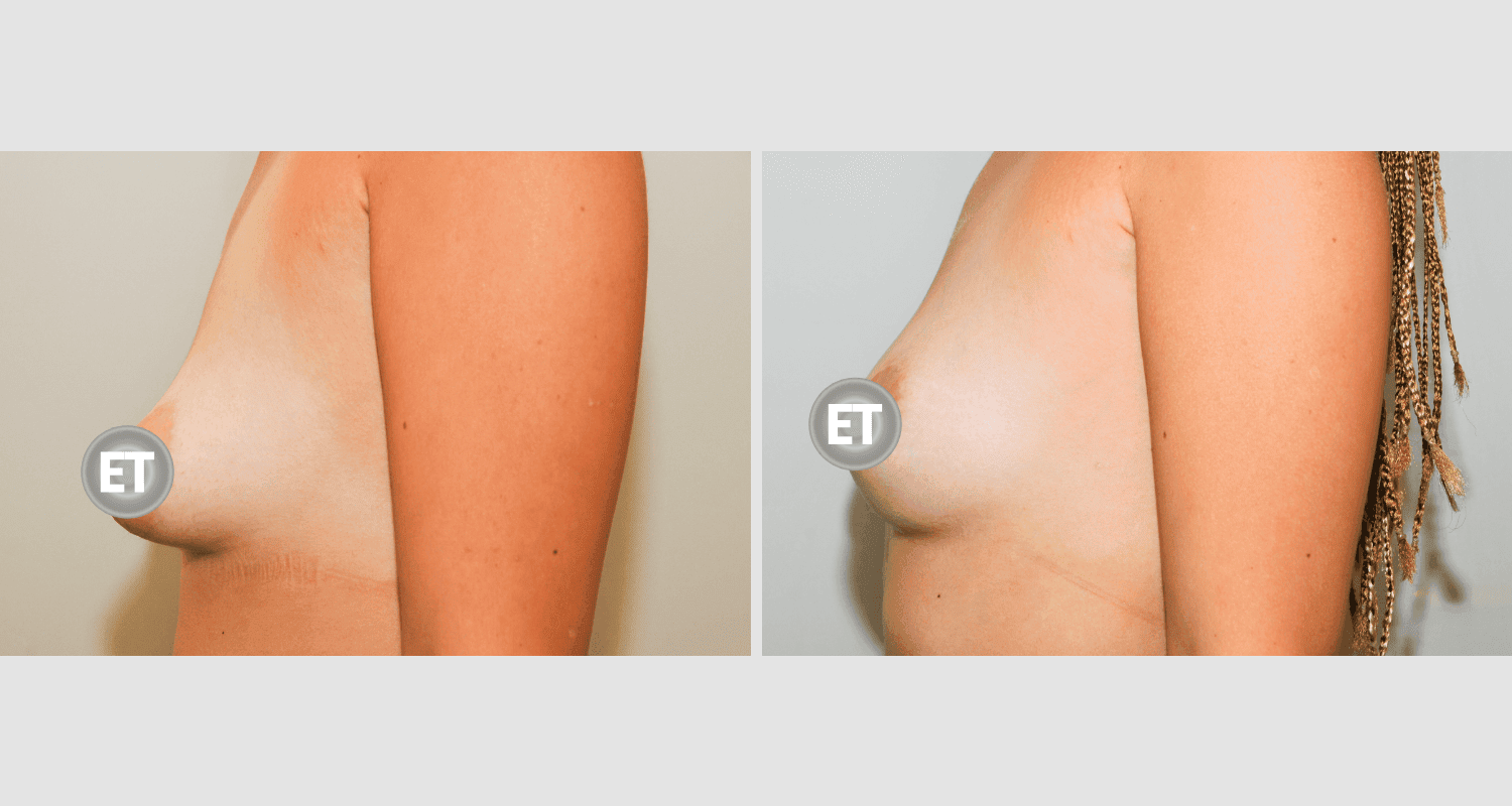 Vorher/Nachher Ergebnis: Mammatubulaere Deformitaet