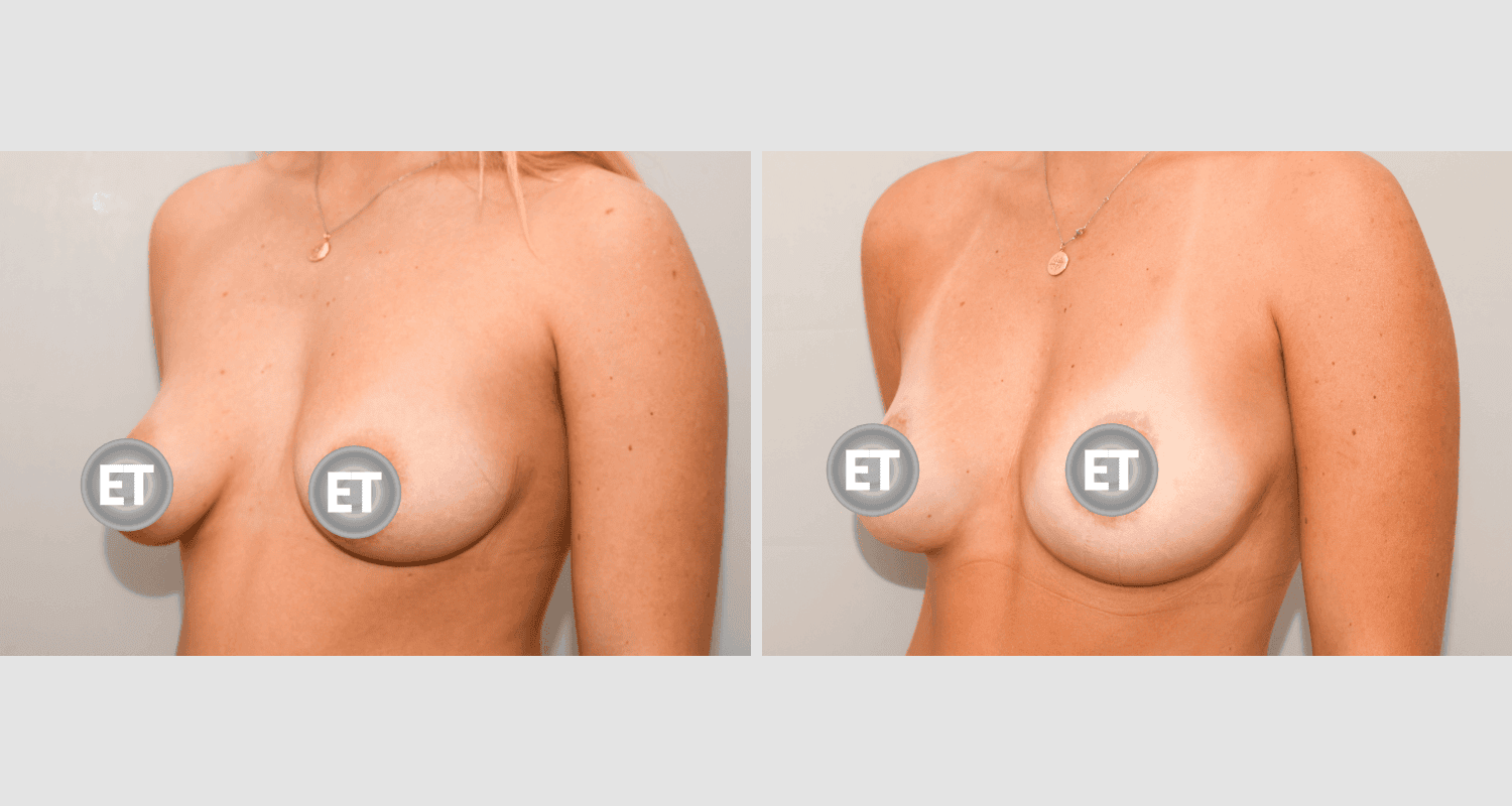 Vorher/Nachher Ergebnis: Mammatubulaere Deformitaet