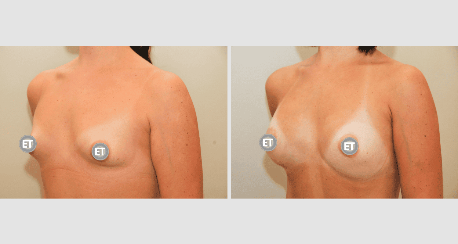 Vorher/Nachher Ergebnis: Mammatubulaere Deformitaet