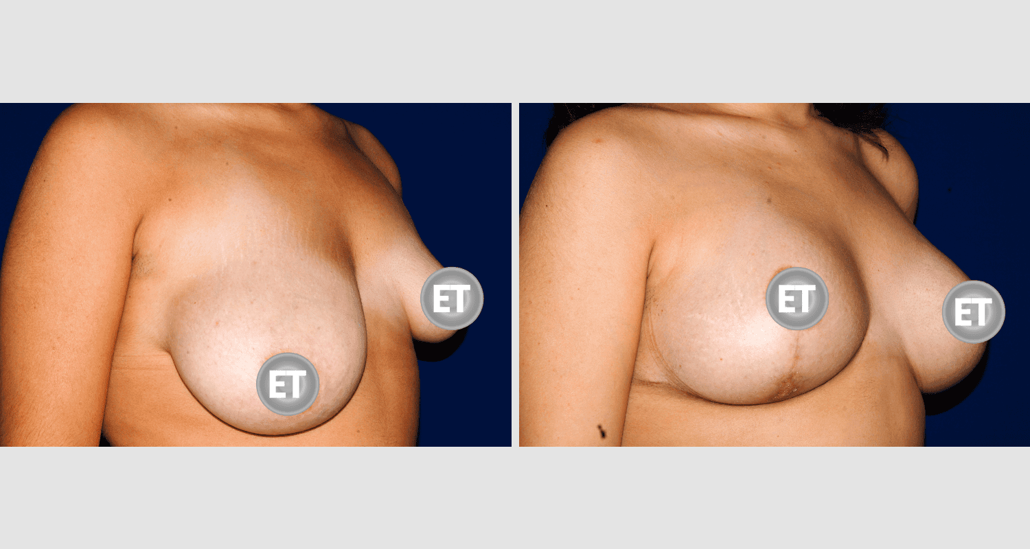 Vorher/Nachher Ergebnis: Mammatubulaere Deformitaet