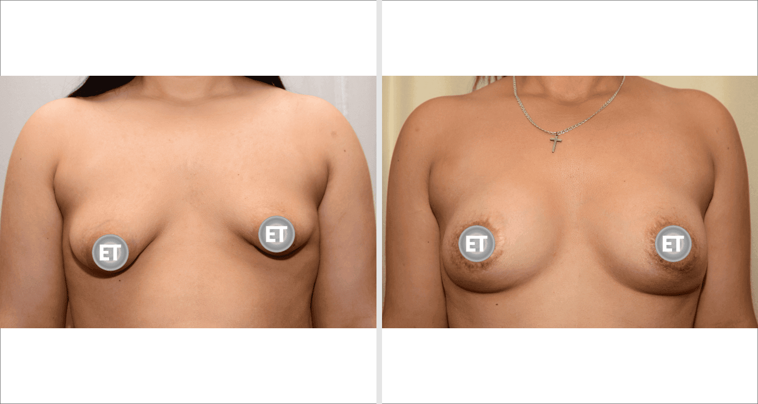 Vorher/Nachher Ergebnis: Mammatubulaere Deformitaet