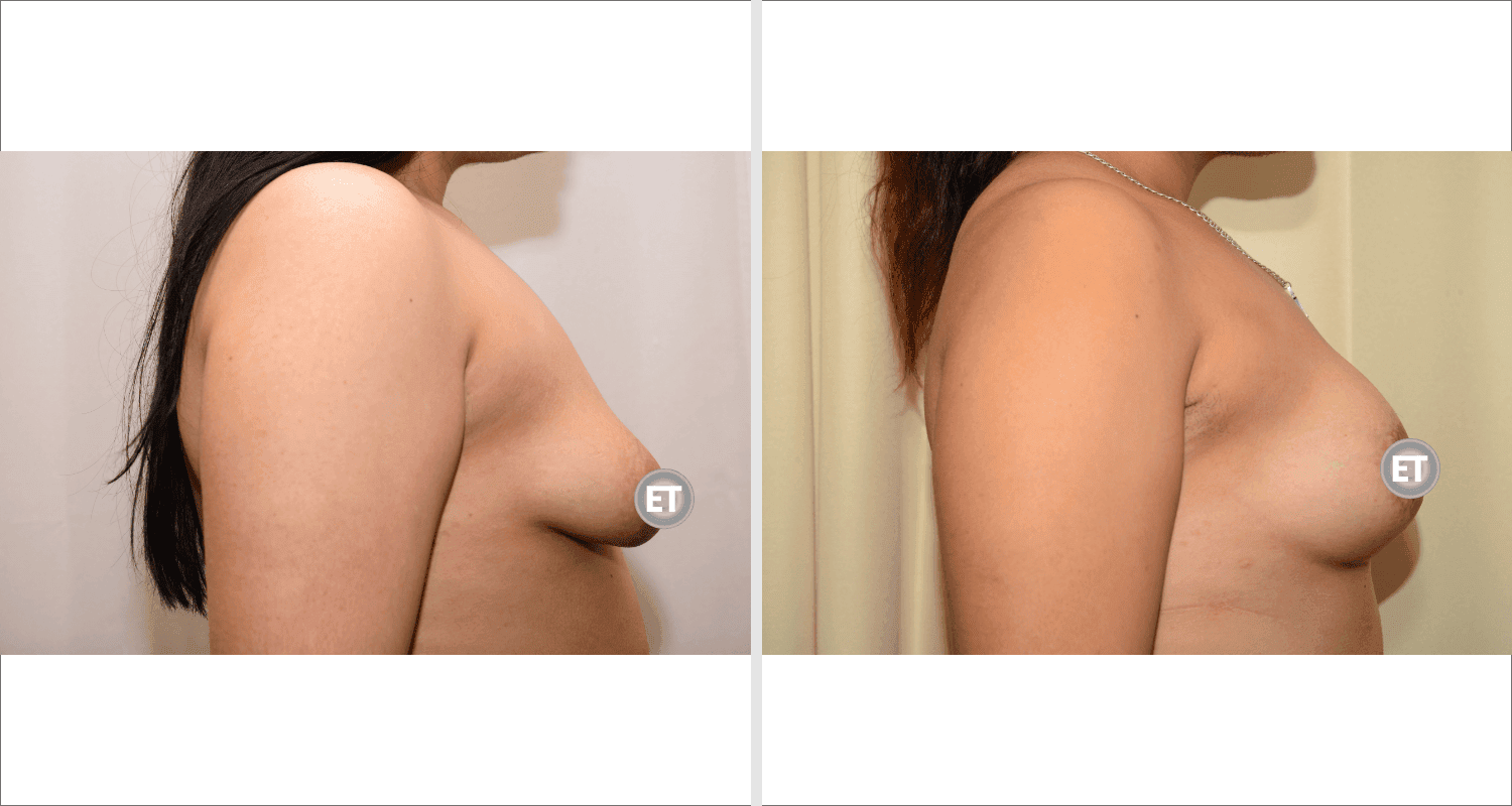 Vorher/Nachher Ergebnis: Mammatubulaere Deformitaet