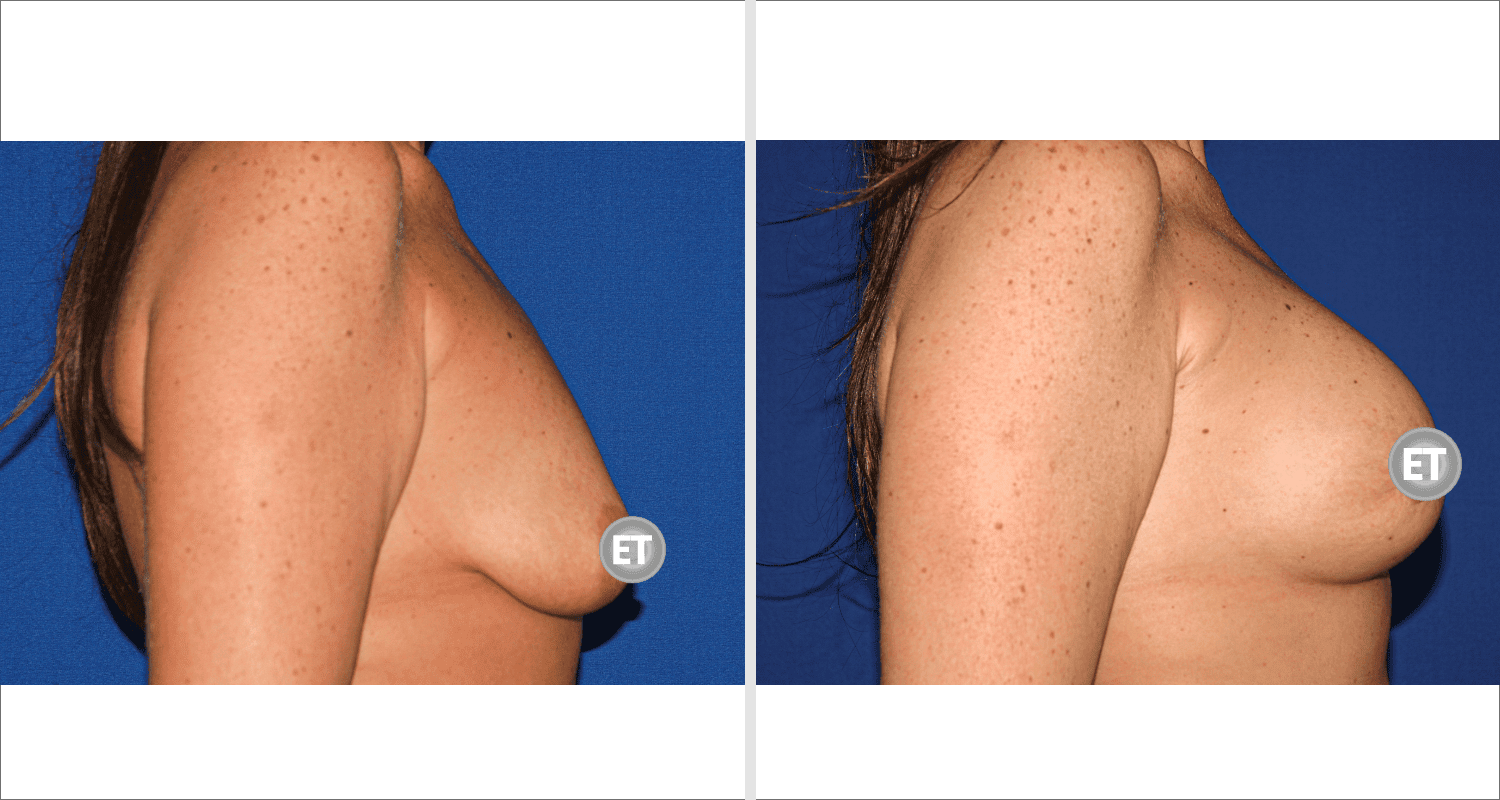 Vorher/Nachher Ergebnis: Mammatubulaere Deformitaet