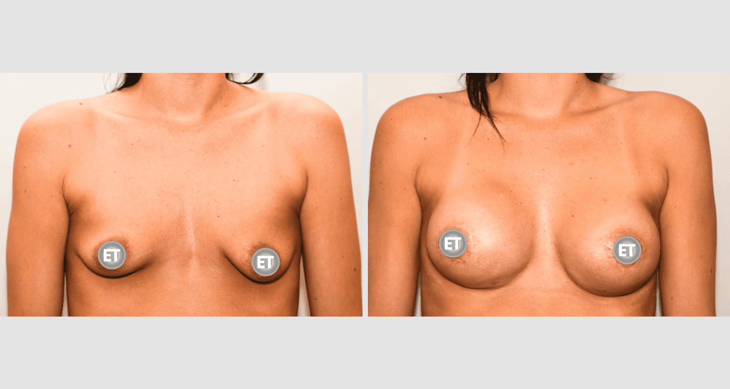 Vorher/Nachher Ergebnis: Mammatubulaere Deformitaet