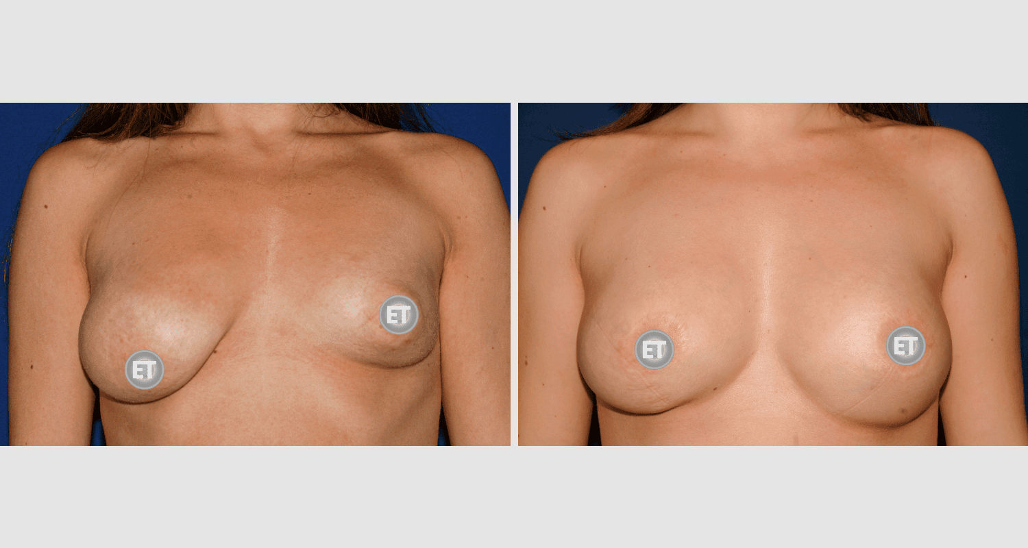 Vorher/Nachher Ergebnis: Mammatubulaere Deformitaet