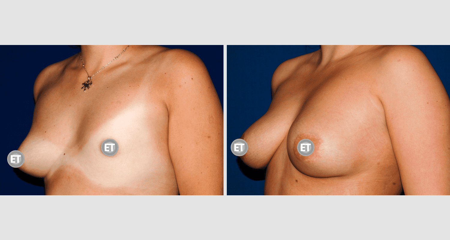 Vorher/Nachher Ergebnis: Mammatubulaere Deformitaet