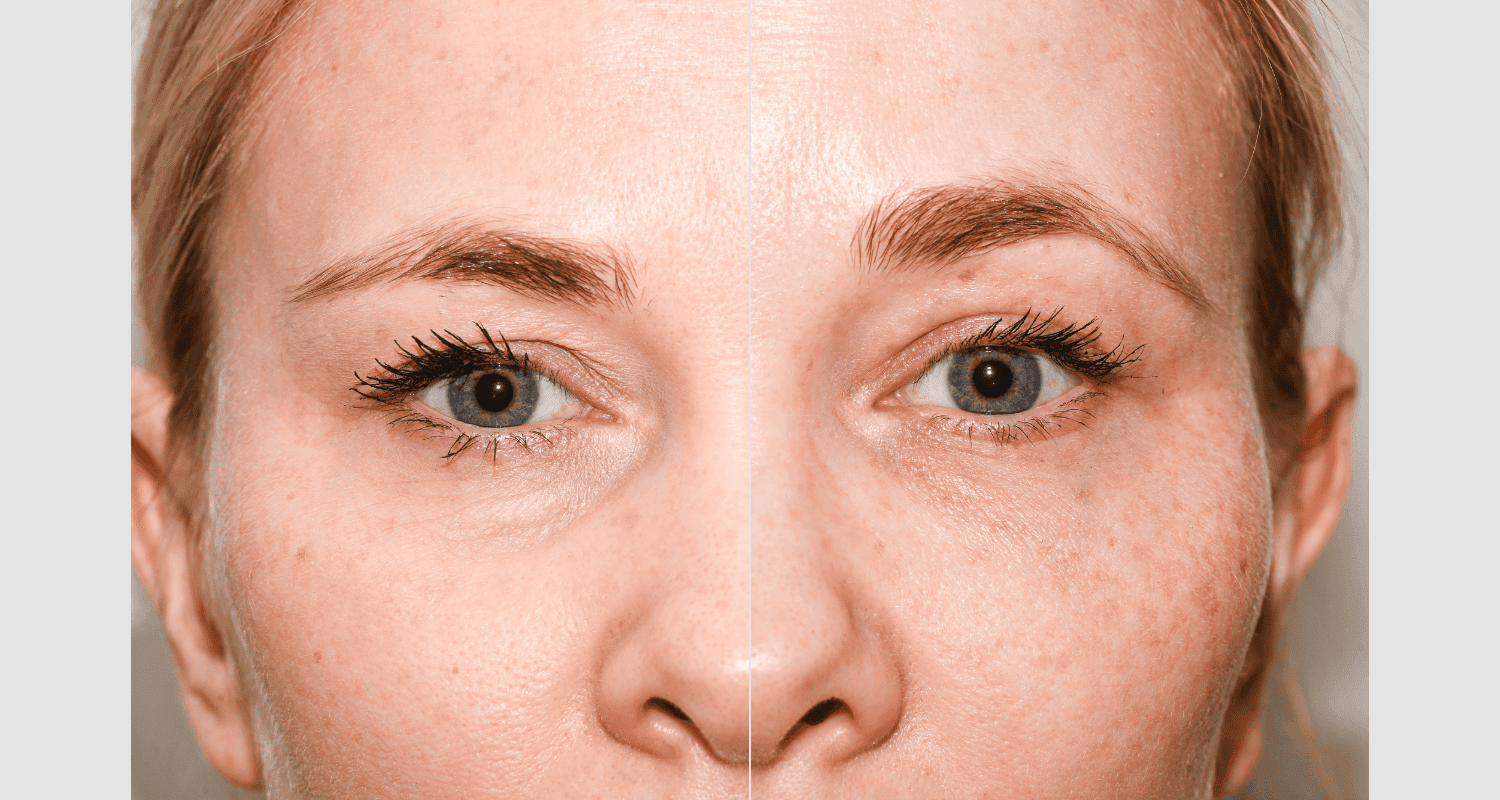 Vergleich von Haut vor und nach einer dermatologischen Behandlung.
