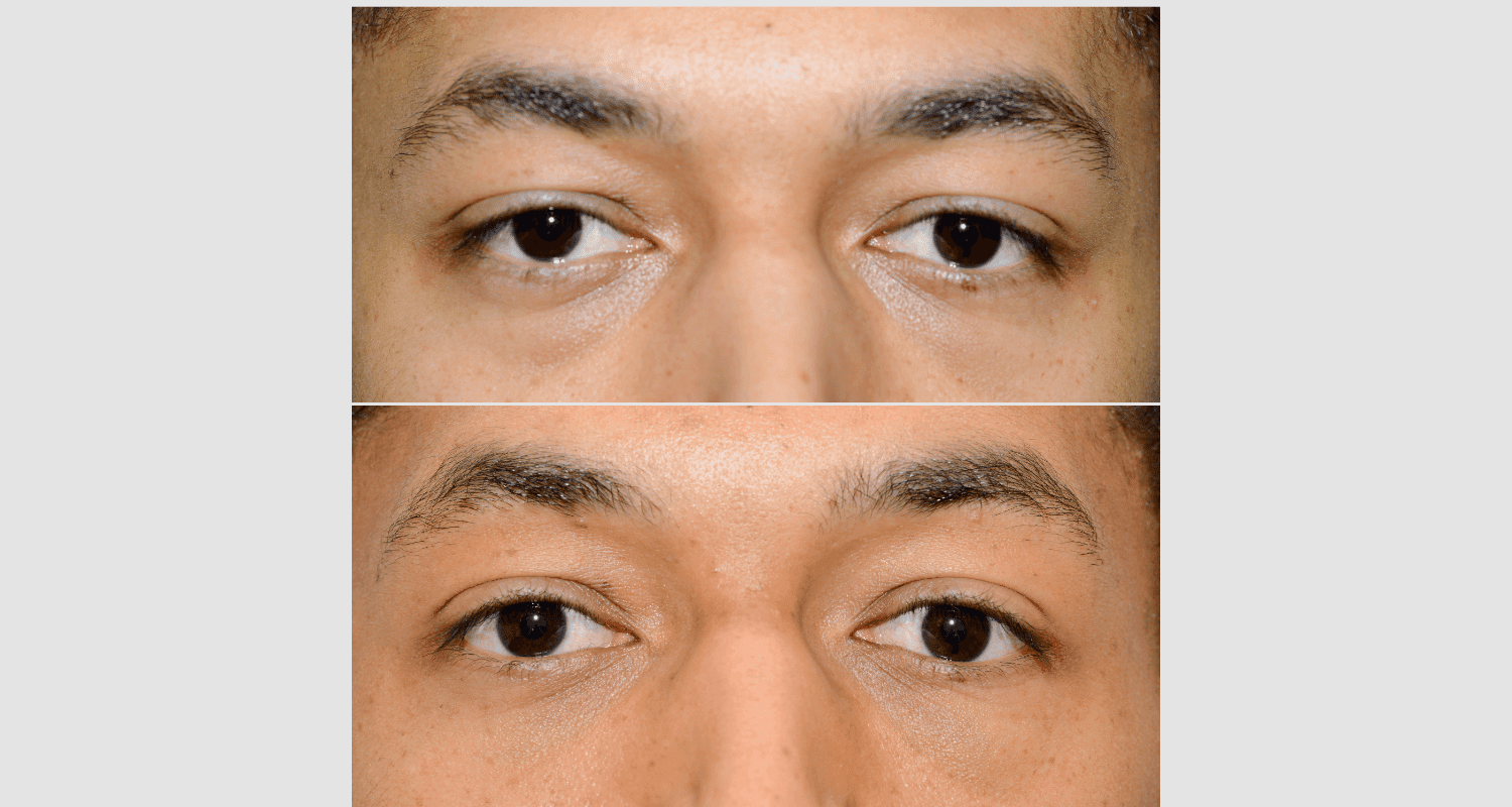 Nahaufnahme von menschlichen Augen vor und nach einer kosmetischen Behandlung.