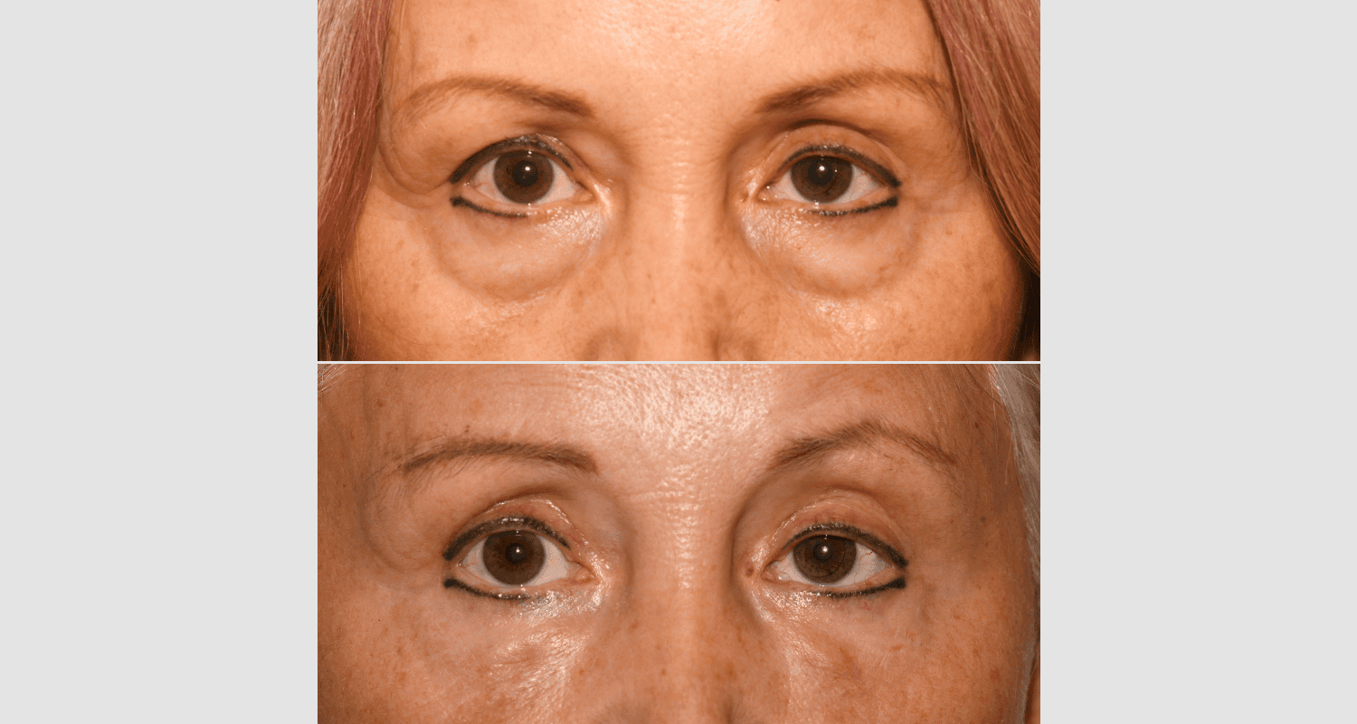 Vorher/Nachher Ergebnis: Unterlidstraffung Korrektur Traenensaecke Augenringe Mini Midfacelift