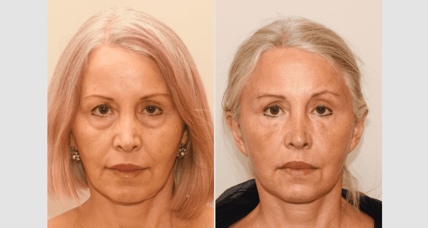 Vorher/Nachher Ergebnis: Unterlidstraffung Korrektur Traenensaecke Augenringe Mini Midfacelift