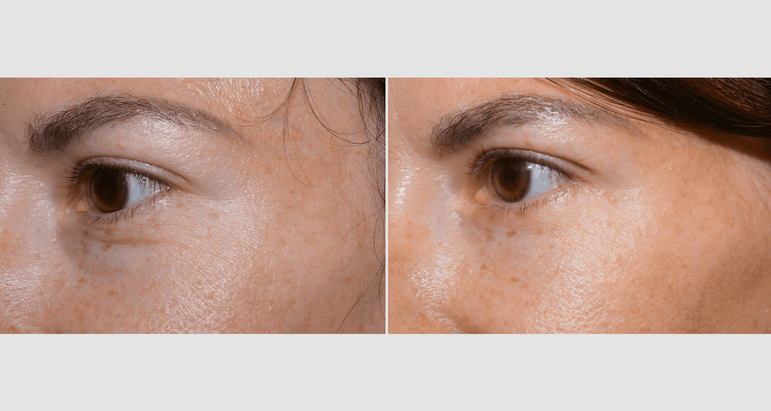 Vorher/Nachher Ergebnis: Unterlidstraffung Korrektur Traenensaecke Augenringe Mini Midfacelift