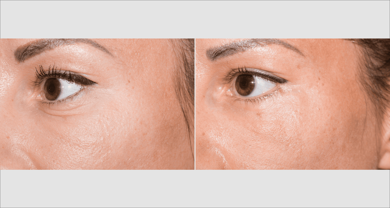 Vorher/Nachher Ergebnis: Unterlidstraffung Korrektur Traenensaecke Augenringe Mini Midfacelift