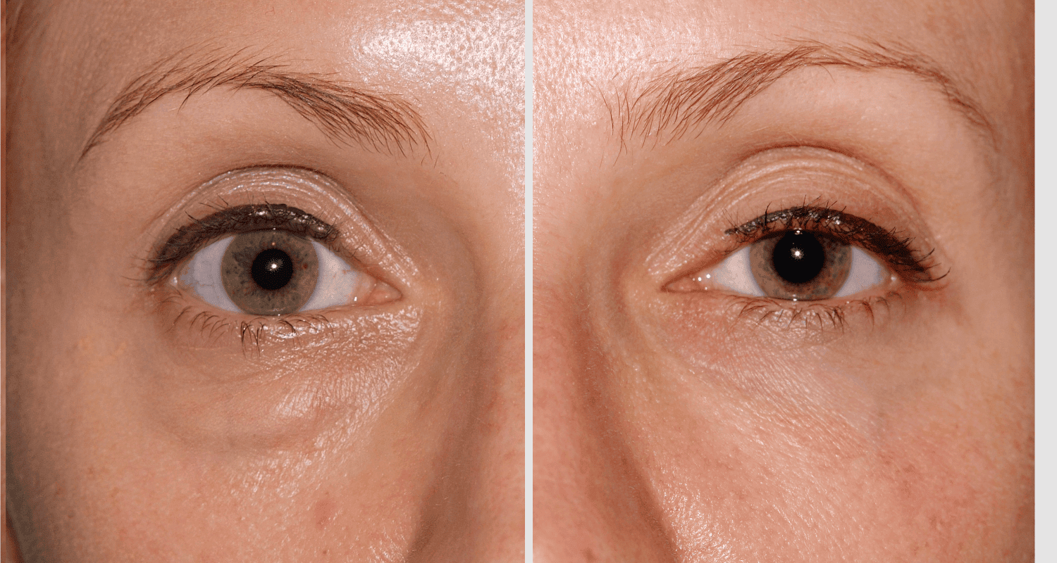 Vorher/Nachher Ergebnis: Unterlidstraffung Korrektur Traenensaecke Augenringe Mini Midfacelift